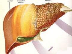 Causas de sufrir un coma hepático Causas de sufrir un coma hepático
