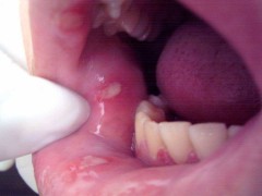 Infecciones recurrentes severas Infecciones recurrentes severas