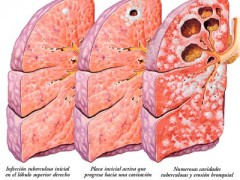 Avances para tratar la tuberculosis Avances para tratar la tuberculosis