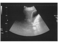 Colelitiasis Colelitiasis
