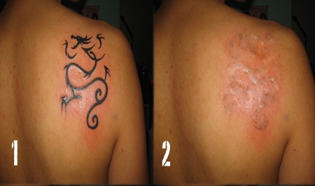 Eliminar tatuajes es un proceso doloroso y prolongado - Cuida tu salud con Diane Pérez